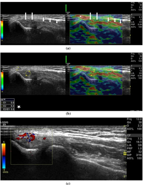 Fig.  1   a Thirty-six-year-old man with lateral elbow pain. On the left  side B-mode sonography image and on the right side elastography  image seen together