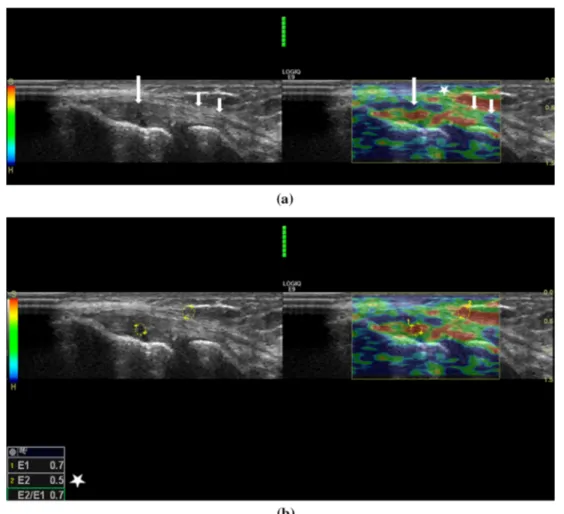 Fig.  2   a Forty-two-year-old woman with lateral elbow pain. On the  left side B-mode sonography image and the right side elastography  image seen side by side