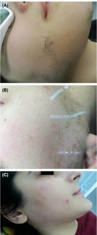 Figure 1.  (a) facial hairs just after dyeing with eyelash masquerade. (b) tempo- tempo-rary superficial crusting after the dye aided 1 st nd:yaG laser epilation session
