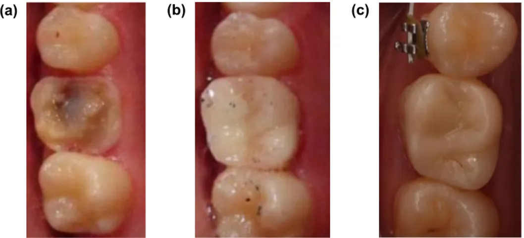Figure 1. representative photos of an overlay on the right 1st maxillary molar (a) initial situation after  endodontical treatment, (b) baseline situation and (c) at 2 years.