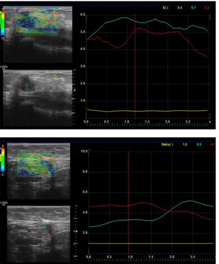 Figure 1.  A 15×11 mm mass with irregular  margins and a strain index ratio of 11. 