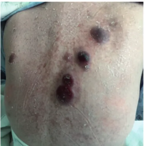 Figure 1. Cutaneous leukemic nodules on the torso of the patient.