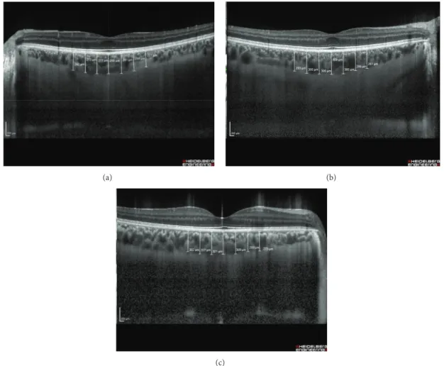 Figure 1: Representative EDI-OCT images of the choroid of a patient with FUS and a healthy control subject