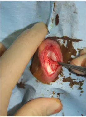 Fig. 3. A photo of a medial condyle in which we created a four-millimeter-diameter and two-millimeter-deep OCD