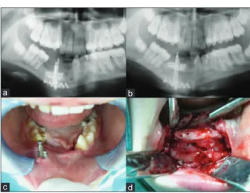 Figure 5: Intraoperative photographs of the vertical alveolar  distraction operation