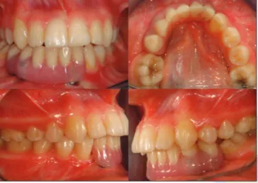 Figure 7: Dental implant and prepared titanium abutments. Hybrid  prosthesis and intaglio surface of the denture