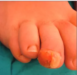 Fig. 3 Sagittal T1 MR image of the right foot shows a subungual exostosis  in the third toe.