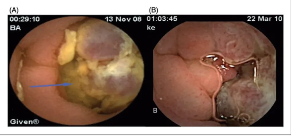 Figure 3. Outcomes of patients (n ¼ 11) with a retained capsule during capsule endoscopy