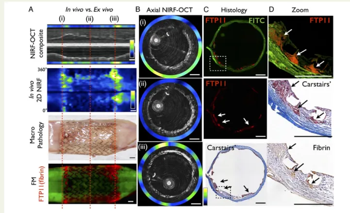 Figure 1 Intravascular near-infrared fluorescence-optical coherence tomography imaging of fibrin deposition on stents