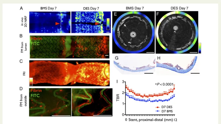 Figure 2 Drug-eluting stent exhibit greater fibrin deposition than bare metal stent at Day 7 in vivo