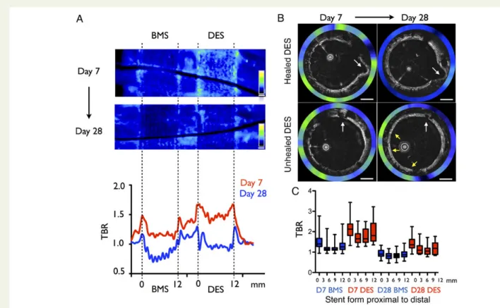 Figure 3 Fibrin deposition and persistence is higher in drug-eluting stent than bare metal stent