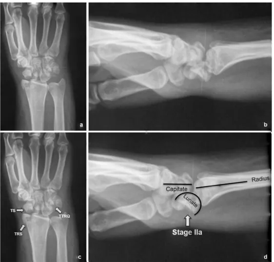 Fig. 1. a, b. The anteroposterior (AP) and lateral radiographs of left wrist of a 25 year-old female after fall from height