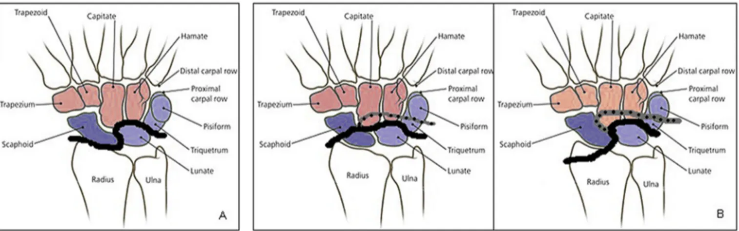 Fig. 5. The progression of injury from radial to the ulnar sides according to the Mayﬁeld classiﬁcation