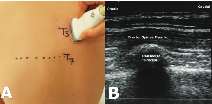 Figure 2A. Probe localization in a longitudinal direction during ESPB performing at 2-3 cm lateral to the T5 transverse process
