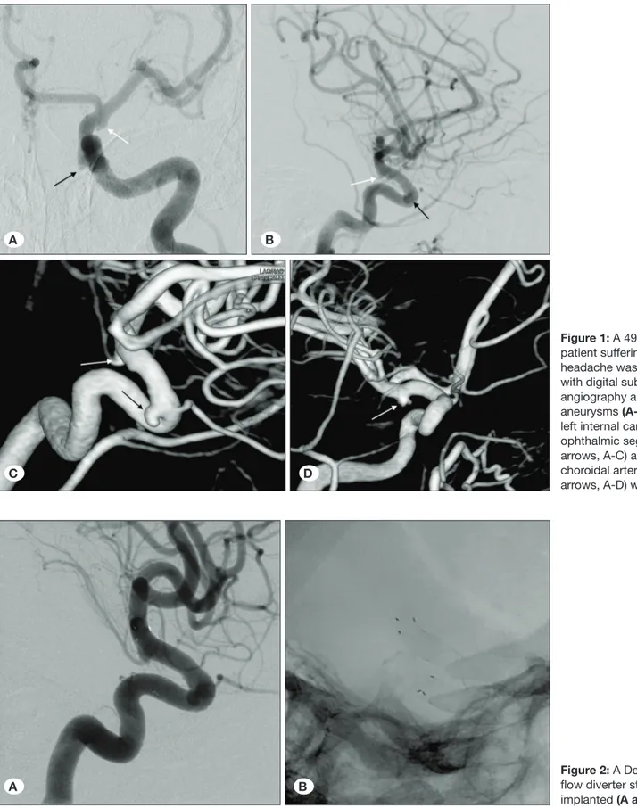Figure 1: A 49-year-old  patient suffering from  headache was evaluated  with digital subtraction  angiography and 2 small  aneurysms (A-D) of the  left internal carotid artery  ophthalmic segment (black  arrows, A-C) and anterior  choroidal artery (white 