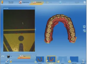 Figure 4: Digital impression of lower jaw using intraoral scanner Figure 2: (a) Conventional impression of upper jaw using condensation type silicone (left side), (b) conventional impression of lower jaw using additional type silicone (right side)