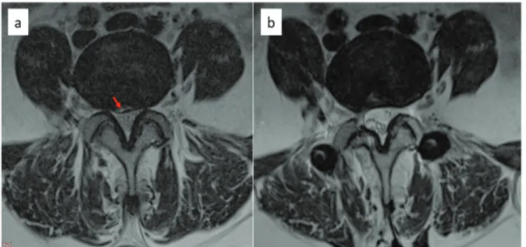 Figure 1. a) weaken but preserved integrity of posterior annulus,  preop axial T2 image b) postop 1-year axial; T2 image shows  healing of annulus
