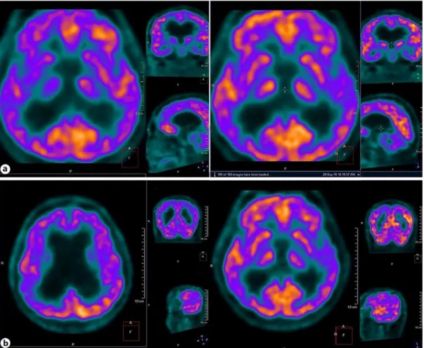 Fig.  2.   Pre-intervention and  postintervention  results  of PET  scan:  improvements  were  observed  in  the  brain metabolic activity after virtual reality-based exergaming
