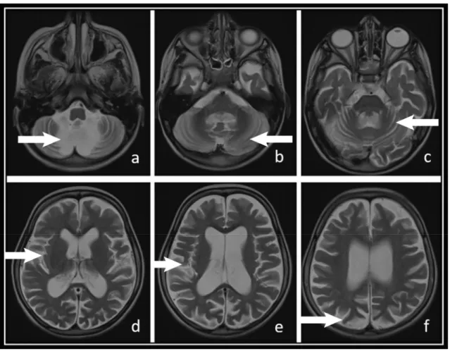 Fig. 1B Patient 1 e T2-weighted axial sections from an MRI scan taken 2 years after the onset of symptoms