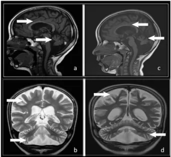 Fig. 1D Patient 2 e T2-weighted axial sections (a, b, c, f), T1-weighted axial section (d) and T1-weighted sagittal section (e) from an MRI scan taken after the ﬁrst seizure
