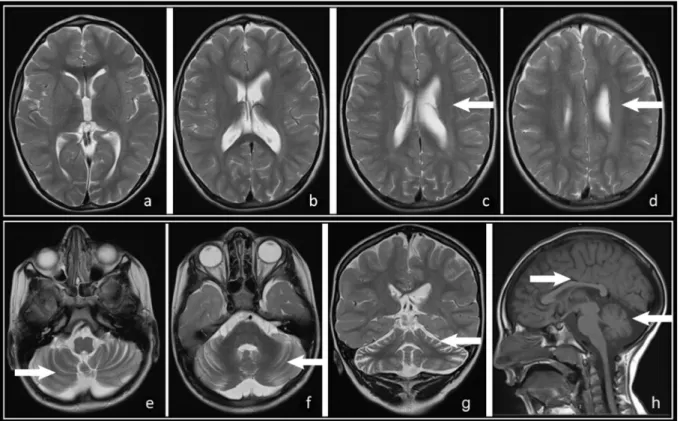 Fig. 1E Patient 3 e T2-weighted axial sections (a, b, c, d, e, f), T2-weighted coronal section (g) and T1-weighted sagittal section (h) from an MRI scan taken after the ﬁrst seizure.