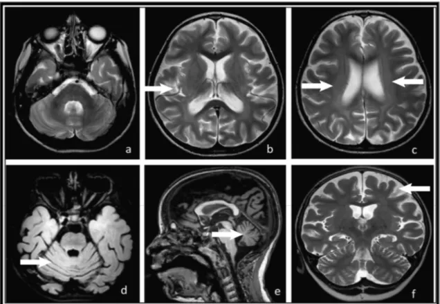 Fig. 1H Patient 5 e T2-weighted axial sections (a, b, c), axial FLAIR section (d), T1-weighted sagittal section (e) and T2-weighted coronal section (f) from an MRI scan taken 2 years after the onset of symptoms