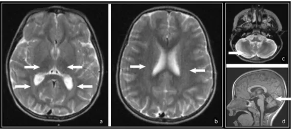 Fig. 1J Patient 6 e MRI scan taken 2 years after the onset of symptoms. Signiﬁcant progression of linear hyperintensity of central white matter is highlighted (c)