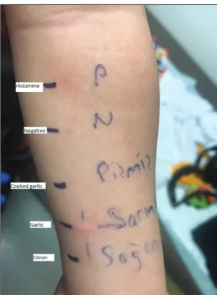 Figure 1. Epidermal prick-to-prick test.
