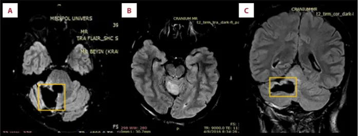 Figure 2.  Postoperative magnetic resonance imaging (MRI) scans of the patient. (A) MRI transverse flair sense on March 20, 2017