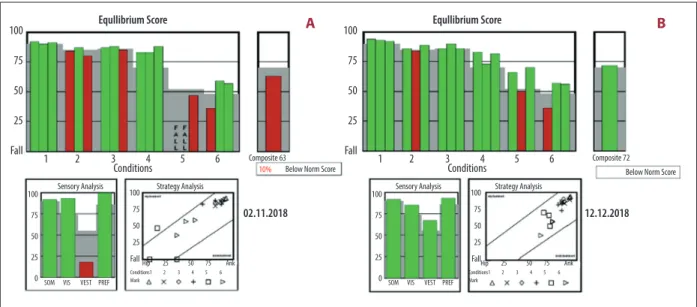Figure 5.   (A) After 2 years when the patient was admitted to the Audiology Department, the sensory organization test (SOT) composite  equilibrium score was determined as 63