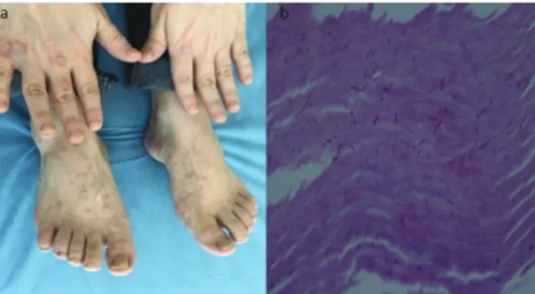 Figure  1.  a)  A  psoriasis  case  presenting  with  onychomycosis  in  hand  and  foot  nails,  b)  demonstration  of  fungal  hyphae  by  the  histopathological examination of the nail sample using periodic  acid-Schiff stain