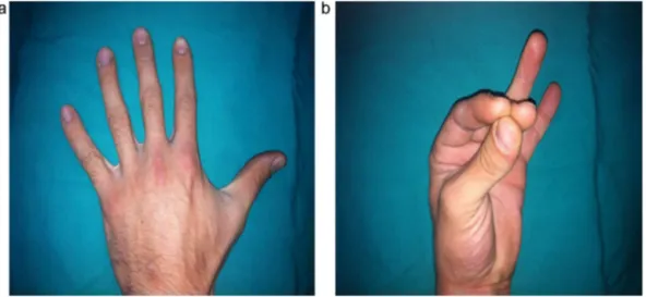 Fig. 3. a and b View of the injured hand while forming ﬁst.