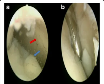 Fig. 1 a First view of the MTP joint by the 30° scope. The blue arrow is the metatarsal head