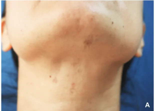 Figure  1A. Depressed band like hyperpigmented lesions  over left side of chin along the neck