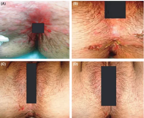 FIGURE 1  A, Indicates a first-day  lesion before treatment. B, indicates a  third-day post-treatment lesion