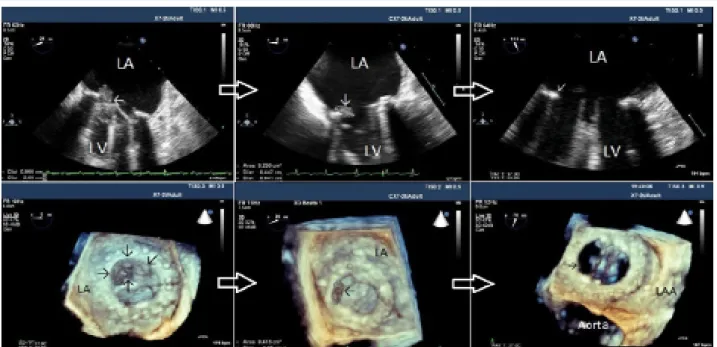 Figure 1. Serial 2-dimensional and real-time 3-dimensional transesophageal echocardiography images of obstructive prosthetic  mitral valve thrombosis that was successfully treated with a low-dose ultra-slow infusion of tissue-type plasminogen activator