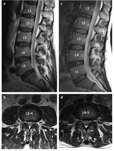 Figure 2. X-ray graphy of L4-5 transforaminal injection/A, B Anteri- Anteri-or-posterior images, C Lateral image.