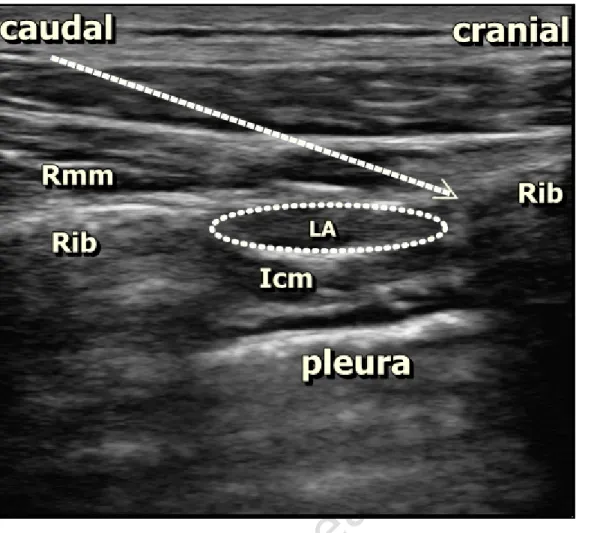 Figure 1. Sonographic anatomy of block, needle direction, and spread of local anesthetic (LA)