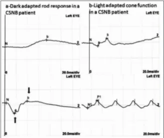 FIGURE 2: Normal electroretinography of control patient 10.The amplitude of b-wave is larger than a-wave.