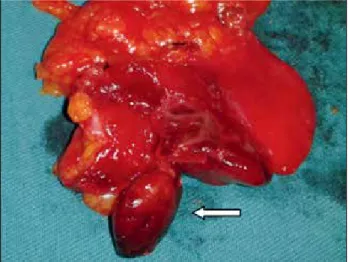 Figure 3. The same patient. Macroscopic view of the surgical  specimen showing necrotic fat tissue at the falciform ligament  (arrow).