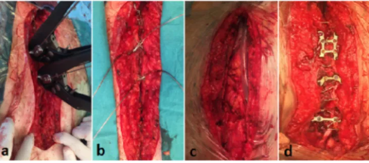 Figure 2. Operative view of the different sternum closure. A and B,  sternal cable placement; C and D, fractured sternum and plate fixation