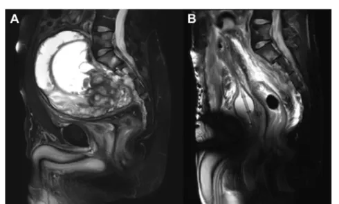 Figure 1. ( A) Preoperative sagittal T2-weighted (T2WI) magnetic resonance imaging (MRI) showing a large retroperitoneal tumor involving the left hemipelvis and compressing the bladder and bowels.
