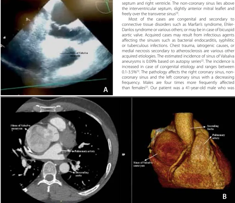 Fig. 1 – A) Echocardiography indicates dilatation of the non-coronary sinus; B) Computer tomography shows the aneurysm of the non- non-coronary sinus of Valsalva.