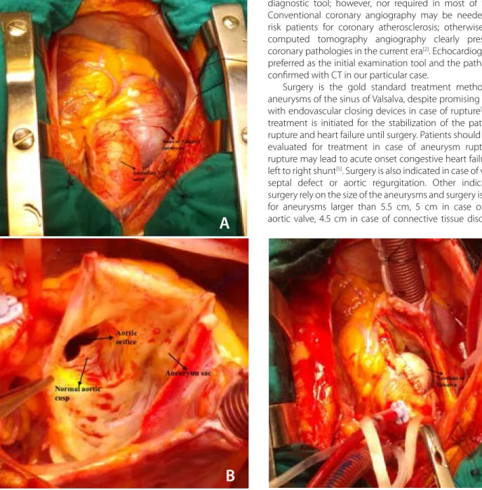 Fig. 2 – A) Perioperative view of the aneurysm; B) Aneurysm sac opened, showing normal aortic cusps; C) Biologic patch repair of the aneurysm  of the non-coronary sinus of Valsalva.