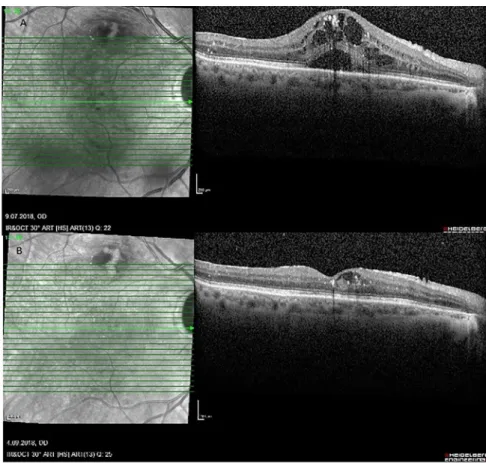 Figure 3.  Optical coherence tomography images of a patient with serous retinal detachment before and after  intravitreal dexamethasone implantation.