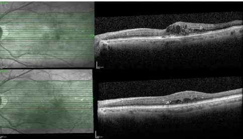 Figure 4.  Optical coherence tomography images of a patient without serous retinal detachment before and  after intravitreal dexamethasone implantation.