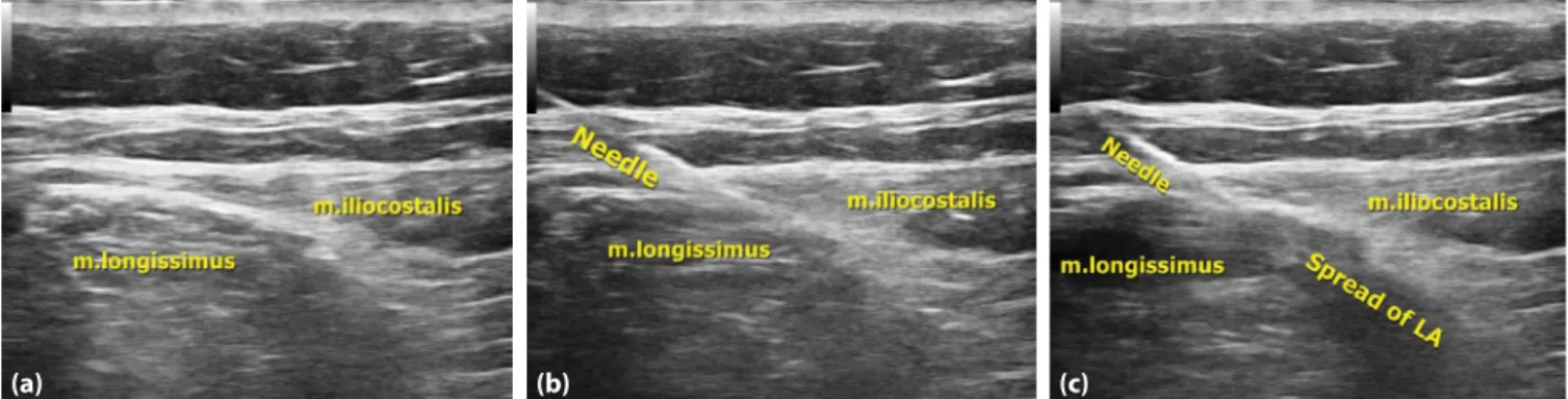 Figure 1. (a) Sonographic anatomy of the block region. (b) The needle direction between longissimus and iliocostalis muscles