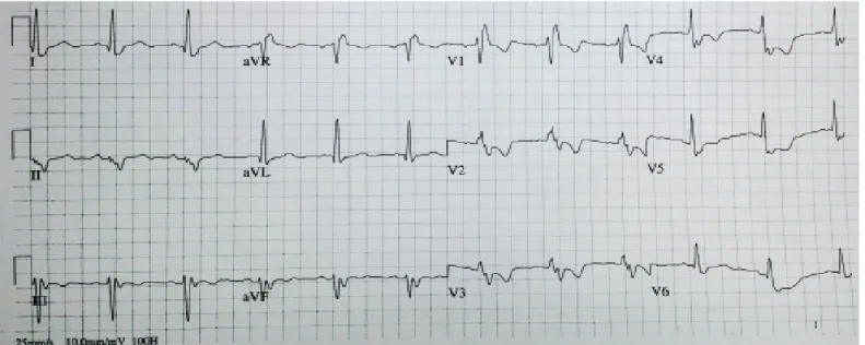 Figure 4. Twelve-lead ECG recorded with correctly-placed ECG electrodes, revealing sinus rhythm with a different morphology of the P wave and  QRS complexes compared with Figure 3, with positive P waves in leads II, III, and aVF; positive in leads I and aV