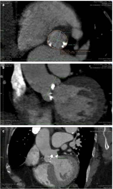 Figure 1. Computed tomography images before transcatheter aortic  valve implantation; (a) An annulus size of 24.2/28 mm and an annulus  area of 573 mm 2 ; (b) Height of left main coronary artery: 13.5 mm; c)  Diameter of sinus valsalva: 36 mm