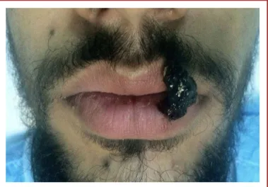 Figure 2. (a) Pyogenic granuloma located on the upper lip. (b) Its  appearance following elliptic excision